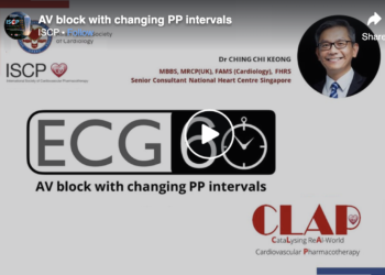 AV Block with Changing PP Intervals